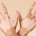 Opzelura The first drug to restore pigmentation for vitiligo patients