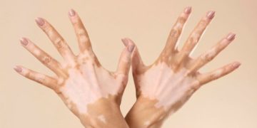 Opzelura The first drug to restore pigmentation for vitiligo patients
