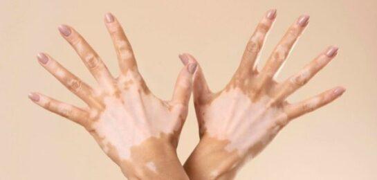 Opzelura The first drug to restore pigmentation for vitiligo patients
